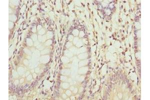 Immunohistochemistry of paraffin-embedded human colon cancer using ABIN7176363 at dilution of 1:100 (ZNF544 anticorps  (AA 1-230))