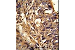 Formalin-fixed and paraffin-embedded human lung carcinoma reacted with ETFDH Antibody (N-term), which was peroxidase-conjugated to the secondary antibody, followed by DAB staining.