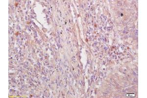 Formalin-fixed and paraffin embedded human lung carcinoma labeled with Rabbit Anti VE Cadherin/VECD/CD144 Polyclonal Antibody, Unconjugated (ABIN1387250) at 1:200 followed by conjugation to the secondary antibody and DAB staining (Cadherin 5 anticorps  (AA 251-320))