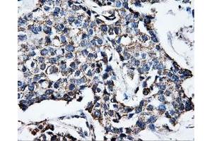 Immunohistochemical staining of paraffin-embedded Adenocarcinoma of breast tissue using anti-ATP5B mouse monoclonal antibody.