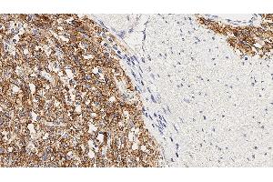 Human colon, gastrointestinal stromal tumor: immunohistochemical staining for DOG-1.
