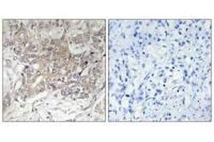 Immunohistochemistry analysis of paraffin-embedded human liver carcinoma tissue using GCNT3 antibody.