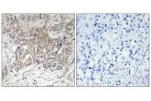 Immunohistochemistry analysis of paraffin-embedded human liver carcinoma tissue using GCNT3 antibody. (GCNT3 anticorps)