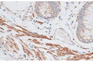 Immunohistochemistry of paraffin-embedded Human colon carcinoma using GRK5 Polyclonal Antibody at dilution of 1:100 (40x lens).