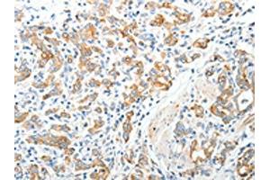 The image on the left is immunohistochemistry of paraffin-embedded Human gastric cancer tissue using (TEP1 Antibody) at dilution 1/40, on the right is treated with synthetic peptide. (TEP1 anticorps)