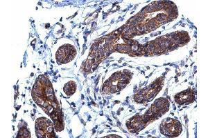 IHC-P Image BCAR1 antibody [N2C2], Internal detects BCAR1 protein at cytoplasm on human breast carcinoma by immunohistochemical analysis.