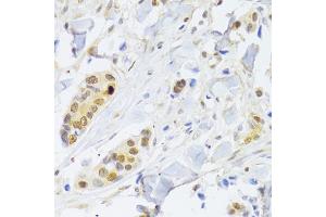Immunohistochemistry of paraffin-embedded human breast cancer using RELA Antibody. (NF-kB p65 anticorps)