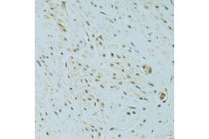 Immunohistochemistry of paraffin-embedded human uterine cancer using NHEJ1 antibody. (NHEJ1 anticorps)