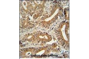 CCD antibody (C-term) (ABIN654259 and ABIN2844079) immunohistochemistry analysis in formalin fixed and paraffin embedded human colon carcinoma followed by peroxidase conjugation of the secondary antibody and DAB staining. (CEP89 anticorps  (C-Term))