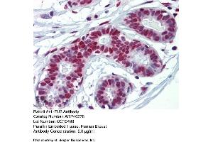 Rabbit Anti-FUS Antibody  Paraffin Embedded Tissue: Human Breast Antibody Concentration: 5 ug/ml (FUS anticorps  (N-Term))