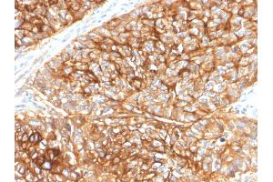 Formalin-fixed, paraffin-embedded human Lung Carcinoma stained with CD9 Mouse Monoclonal Antibody (CD9/2343).