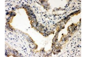 IHC-P: Rad51 antibody testing of human intestine cancer tissue (RAD51 anticorps  (AA 1-258))