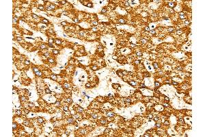 ABIN6258317 and ABIN6274726 at 1/100 staining Human liver cancer and adjacent normal tissues by IHC-P.