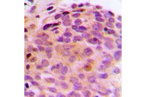 Immunohistochemical analysis of BAG4 staining in human breast cancer formalin fixed paraffin embedded tissue section.