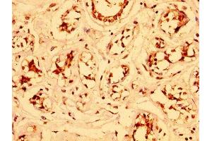 IHC image of ABIN7151937 diluted at 1:300 and staining in paraffin-embedded human breast cancer performed on a Leica BondTM system.