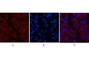 Immunofluorescence analysis of human stomach cancer tissue. (beta Catenin anticorps)