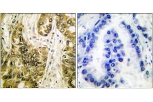 Immunohistochemistry analysis of paraffin-embedded human lung carcinoma tissue, using Galectin 3 Antibody.