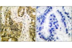 Immunohistochemistry analysis of paraffin-embedded human lung carcinoma tissue, using Galectin 3 Antibody. (Galectin 3 anticorps  (AA 141-190))