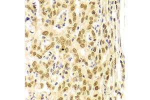 Immunohistochemistry of paraffin-embedded Human gastric cancer using BMI1 antibody at dilution of 1:100 (x400 lens).