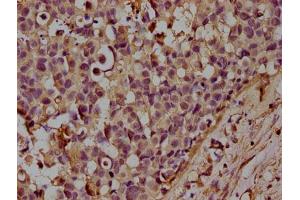 IHC image of ABIN7160185 diluted at 1:100 and staining in paraffin-embedded human breast cancer performed on a Leica BondTM system.