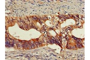Immunohistochemistry of paraffin-embedded human colon cancer using ABIN7161673 at dilution of 1:100 (Olfactomedin 1 anticorps  (AA 374-441))