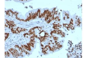 Formalin-fixed, paraffin-embedded human Colon Carcinoma stained with p53 Recombinant Rabbit Monoclonal Antibody (TP53/2092R).