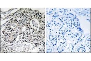 Immunohistochemistry analysis of paraffin-embedded human breast carcinoma, using PXMP2 Antibody. (PXMP2 anticorps  (AA 38-87))