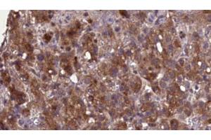 ABIN6276896 at 1/100 staining Human liver cancer tissue by IHC-P. (SLC22A6 anticorps  (C-Term))