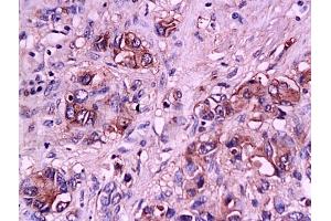 Formalin-fixed and paraffin embedded human gastric carcinoma tissue labeled with Anti-E-Selectin Polyclonal Antibody, Unconjugated (ABIN674244) at 1:200 followed by conjugation to the secondary antibody and DAB staining