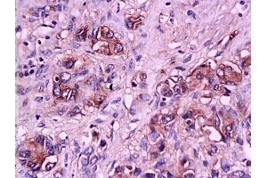 Formalin-fixed and paraffin embedded human gastric carcinoma tissue labeled with Anti-E-Selectin Polyclonal Antibody, Unconjugated (ABIN674244) at 1:200 followed by conjugation to the secondary antibody and DAB staining (Selectin E/CD62e anticorps  (AA 501-612))