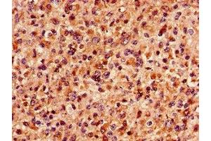 Immunohistochemistry of paraffin-embedded human glioma using ABIN7159758 at dilution of 1:100 (MAP4 anticorps  (AA 575-818))