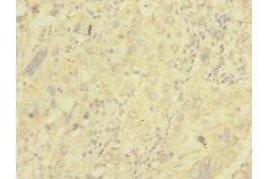Immunohistochemistry of paraffin-embedded human liver cancer using ABIN7147644 at dilution of 1:100