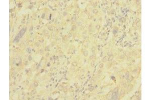 Immunohistochemistry of paraffin-embedded human liver cancer using ABIN7147644 at dilution of 1:100 (NG2 anticorps  (AA 1950-2210))