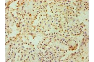 Immunohistochemistry of paraffin-embedded human breast cancer using ABIN7149890 at dilution of 1:100 (DKK4 anticorps  (AA 19-224))