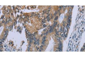 Immunohistochemistry of paraffin-embedded Human colon cancer using CEBPD Polyclonal Antibody at dilution of 1:40