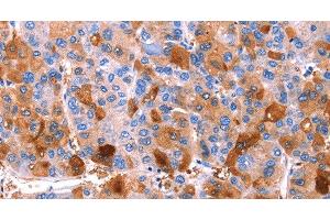 Immunohistochemistry of paraffin-embedded Human liver cancer tissue using ERN2 Polyclonal Antibody at dilution 1:40 (ERN2 anticorps)
