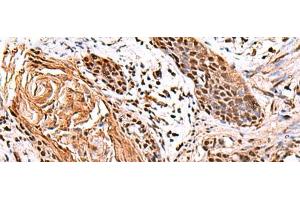 Immunohistochemistry of paraffin-embedded Human esophagus cancer tissue using ITPR2 Polyclonal Antibody at dilution of 1:65(x200) (ITPR2 anticorps)