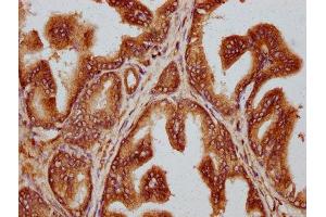 IHC image of ABIN7173707 diluted at 1:300 and staining in paraffin-embedded human prostate cancer performed on a Leica BondTM system.