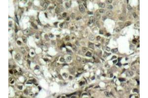 Immunohistochemistry analyzes of c-Abl antibody in paraffin-embedded human breast carcinoma tissue. (ABL1 anticorps)