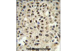 Formalin-fixed and paraffin-embedded human hepatocarcinoma reacted with SSB Antibody (N-term), which was peroxidase-conjugated to the secondary antibody, followed by DAB staining. (SSB anticorps  (N-Term))