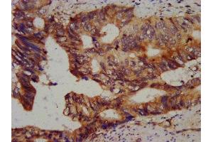 IHC image of ABIN7147529 diluted at 1:800 and staining in paraffin-embedded human colon cancer performed on a Leica BondTM system.