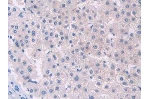 Detection of PCOLCE in Human Liver cancer Tissue using Polyclonal Antibody to Procollagen C-Endopeptidase Enhancer (PCOLCE)