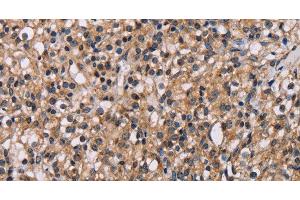 Immunohistochemistry of paraffin-embedded Human prostate cancer using GNL3 Polyclonal Antibody at dilution of 1:60