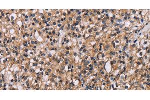 Immunohistochemistry of paraffin-embedded Human prostate cancer using GNL3 Polyclonal Antibody at dilution of 1:60 (Nucleostemin anticorps)