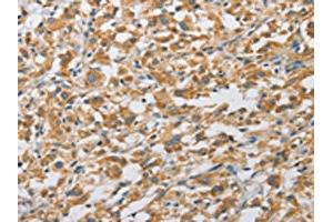 The image on the left is immunohistochemistry of paraffin-embedded Human thyroid cancer tissue using ABIN7128493(ARHGAP5 Antibody) at dilution 1/25, on the right is treated with fusion protein. (ARHGAP5 anticorps)