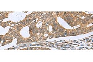 Immunohistochemistry of paraffin-embedded Human colorectal cancer tissue using RPL18 Polyclonal Antibody at dilution of 1:70(x200) (RPL18 anticorps)