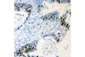 Immunohistochemical analysis of Cyclin C staining in human colon cancer formalin fixed paraffin embedded tissue section. (Cyclin C anticorps)