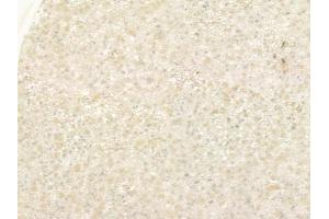 ABIN6257387 and ABIN6275304 at 1/100 staining human astrocytoma by IHC-P.