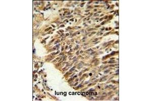 HIF1Alpha Antibody (Center) (ABIN652389 and ABIN2841889) IHC analysis in formalin fixed and paraffin embedded lung carcinoma followed by peroxidase conjugation of the secondary antibody and DAB staining.