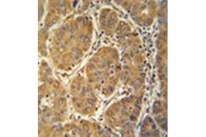 Immunohistochemistry analysis in formalin fixed and paraffin embedded human hepatocarcinoma reacted with MCEE Antibody (C-term) followed which peroxidase conjugated to the secondary antibody and followed by  DAB staining.